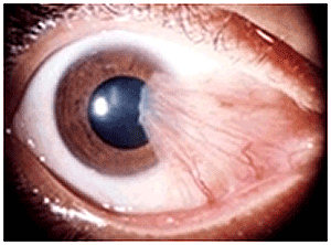 Pterygium