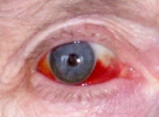 Subconjunctival Haemorrhage